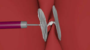 MemoPart™ PFO Occluder